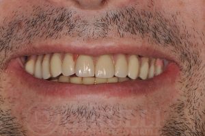 Implantologia dentale - Caso clinico - dopo